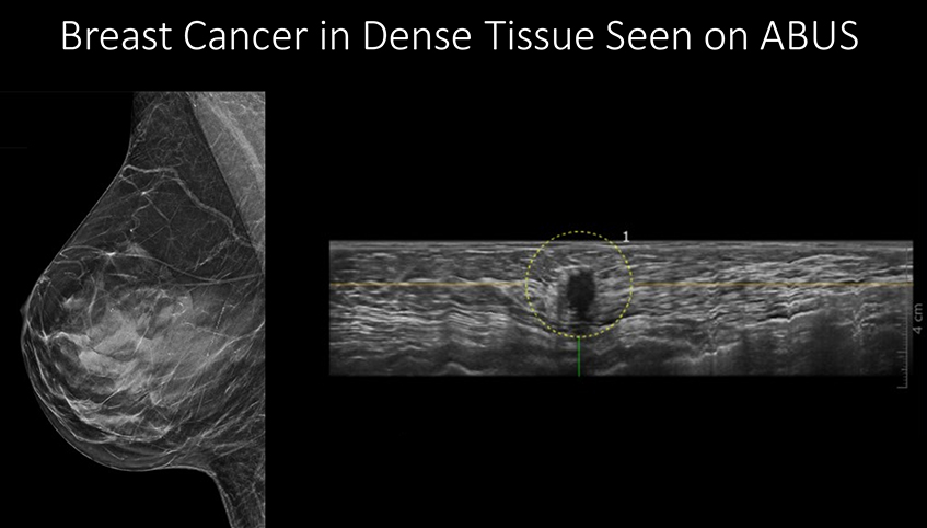 Breast cancer in dense tissue seen on ABUS