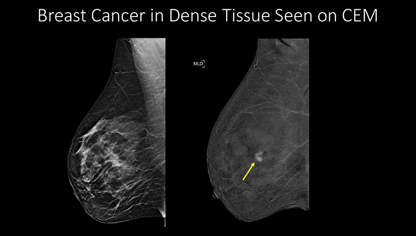 Breast cancer in dense tissue seen on CEM