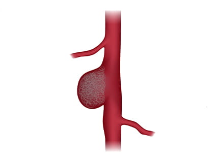 Diagram depicting coiling for stroke treatment